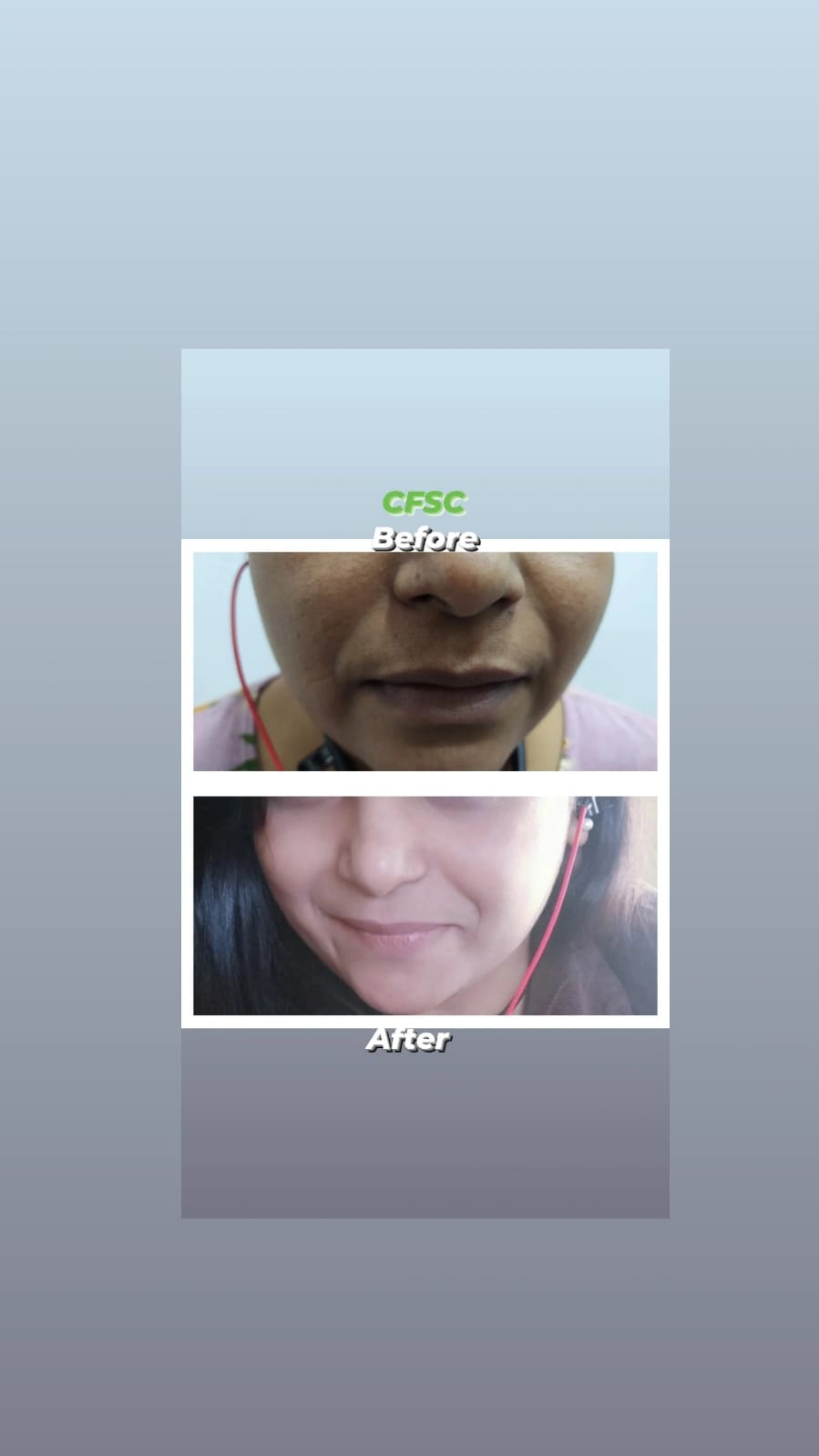 Before After Cosmetic Treatment